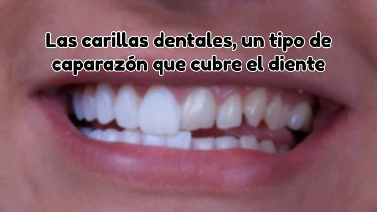 Las carillas dentales, un tipo de caparazón que cubre el diente